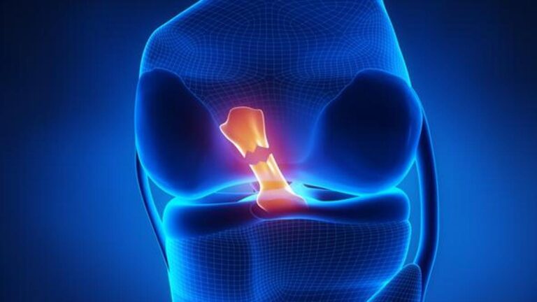 Çapraz bağ ameliyatı ve menisküs yırtığında iyileşme süresi ne kadardır? Icardi’nin sakatlığında son durum!